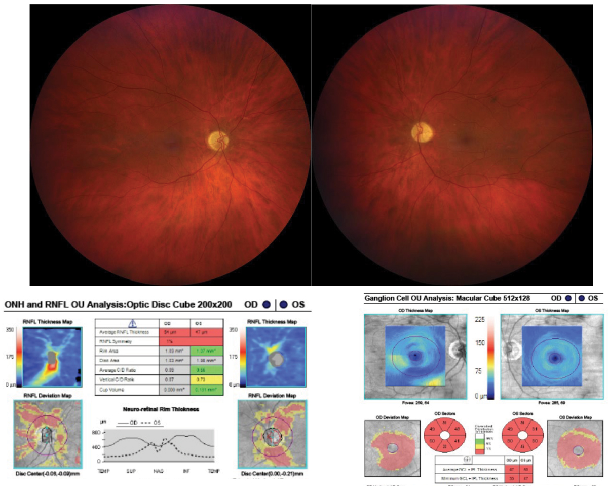 macular-oct-helps-distinguish-maculopathy-from-optic-neuropathy